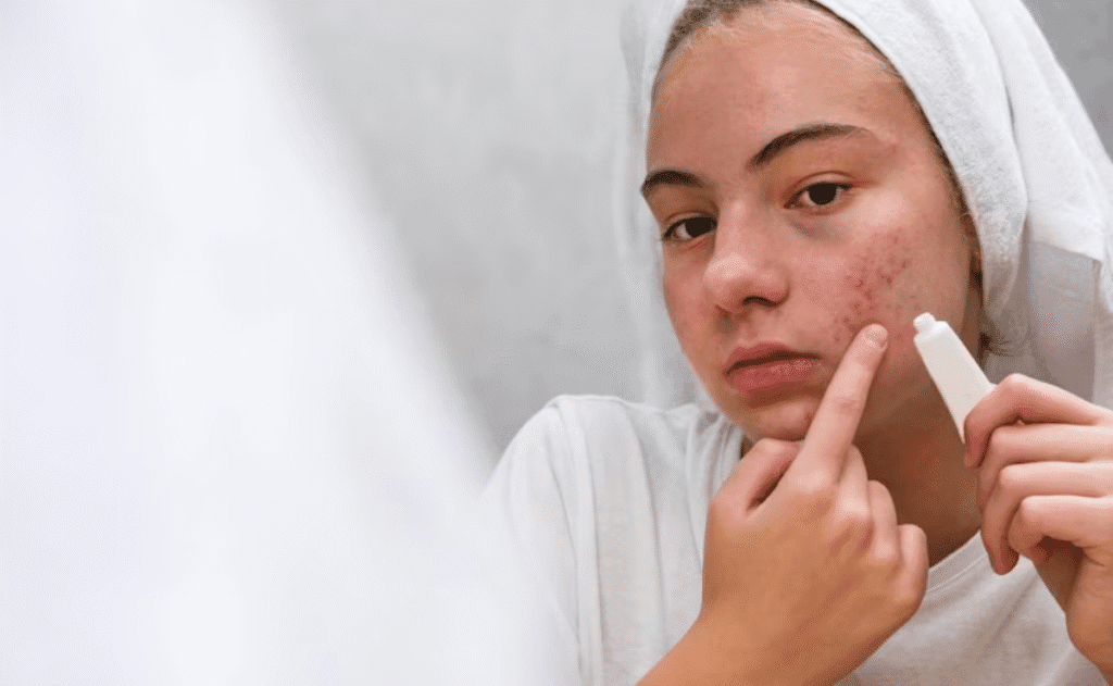 ativos poderosos contra a acne