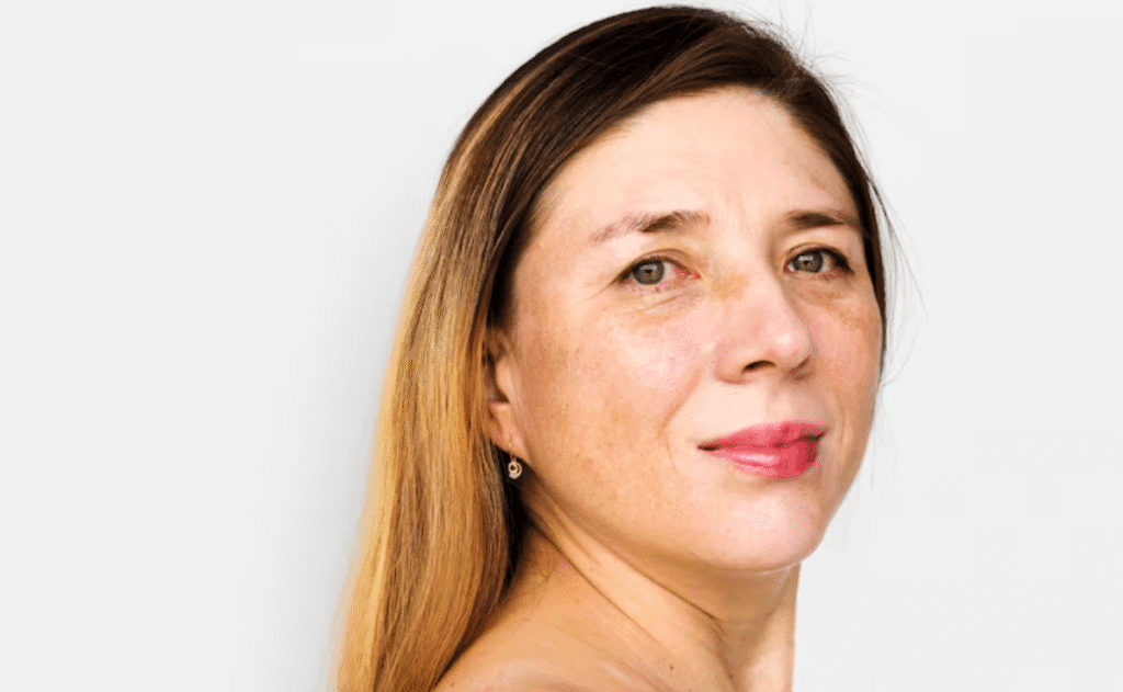 Como evitar melasma na gravidez