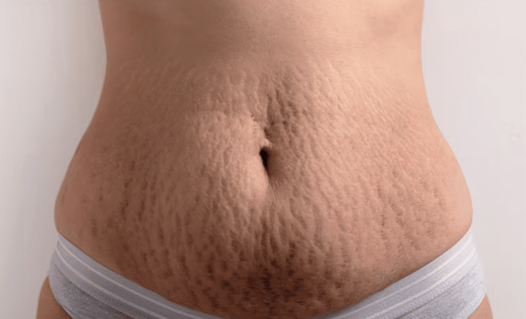 Como Prevenir Estrias: Dicas Naturais para Evitar e Cuidar da Sua Pele